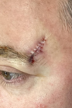 Forehead | ACMS - American College of Mohs Surgery