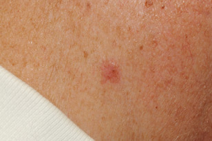 Basal cell carcinoma