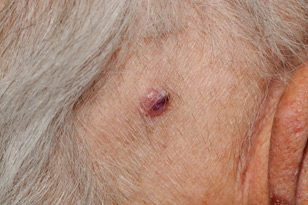 Basal cell carcinoma