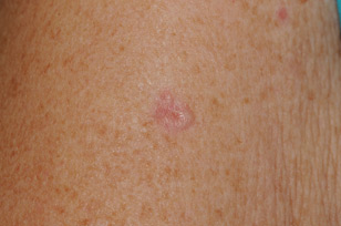 Basal cell carcinoma