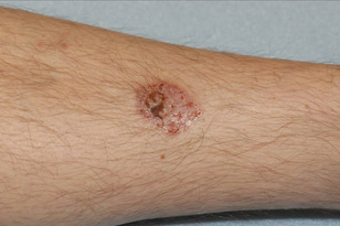 Basal cell carcinoma