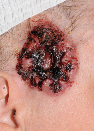 Basal cell carcinoma