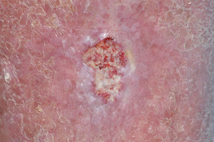 Squamous Cell Cancer